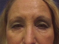 Eyelid and Upper Facial Surgery