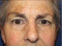 Eyelid and Upper Facial Surgery