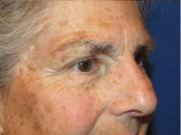 Eyelid and Upper Facial Surgery