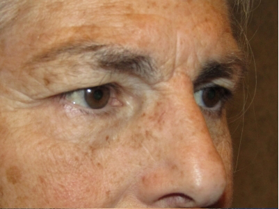 Eyelid and Upper Facial Surgery