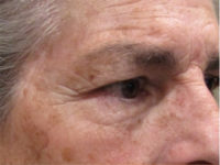 Eyelid and Upper Facial Surgery