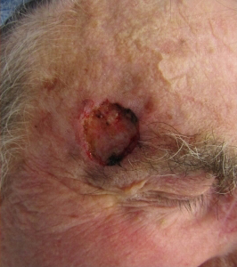 Skin Cancer Reconstruction