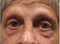 Eyelid and Upper Facial Surgery