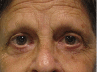 Eyelid and Upper Facial Surgery