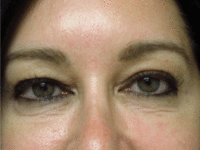 Eyelid and Upper Facial Surgery