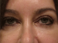 Eyelid and Upper Facial Surgery