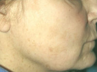 Skin Laser Resurfacing