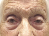 Eyelid and Upper Facial Surgery