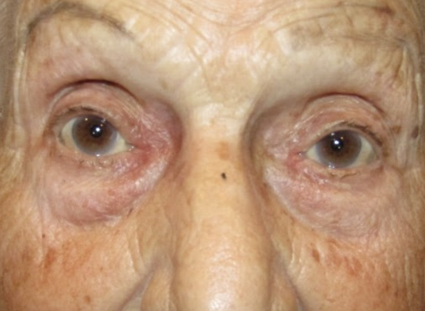 Eyelid and Upper Facial Surgery