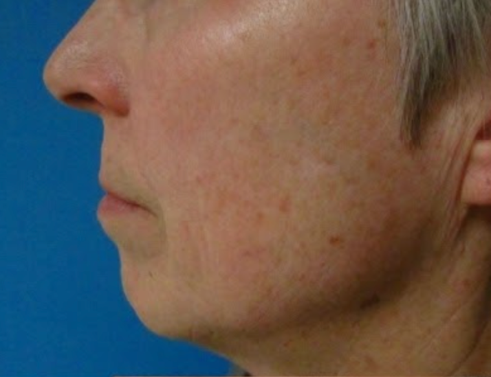 Laser to Remove Brown Spots