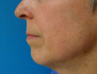 Laser to Remove Brown Spots