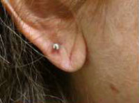 Earlobe Repair