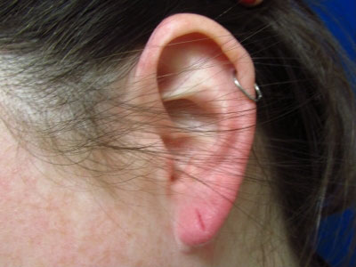 Earlobe Repair