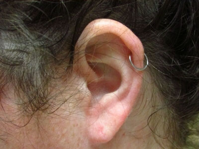 Earlobe Repair