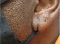 Earlobe Repair