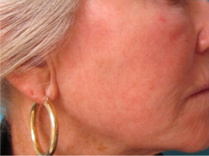 Laser to Remove Brown Spots