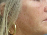 Laser to Remove Brown Spots