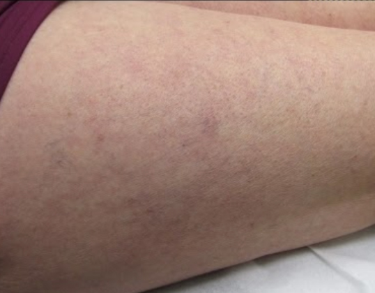 Sclerotherapy