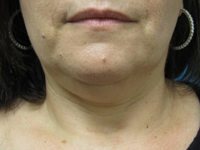 Neck Liposuction