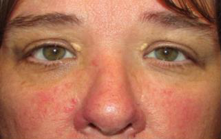 Xanthelasma