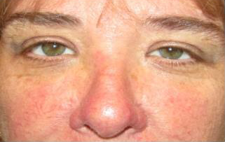 Xanthelasma