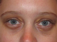 Xanthelasma