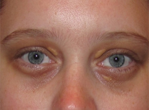 Xanthelasma