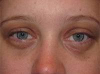 Xanthelasma