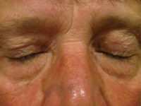 Xanthelasma