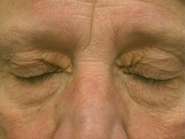 Xanthelasma