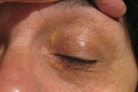 Xanthelasma