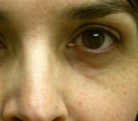 Xanthelasma