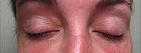 Xanthelasma