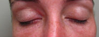 Xanthelasma