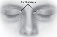 Diagram of Xanthelasma