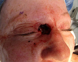 Skin Cancer Reconstruction