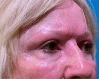 Skin Cancer Reconstruction