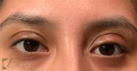 Eyelid and Upper Facial Surgery