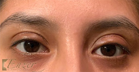 Eyelid and Upper Facial Surgery