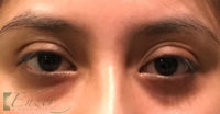 Eyelid and Upper Facial Surgery