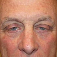 Eyelid and Upper Facial Surgery