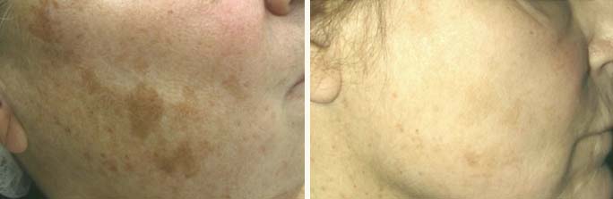 Laser Skin Resurfacing before and after photos by Rhode Island surgeon Dr. Yoash Enzer