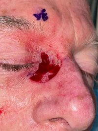 Skin Cancer Reconstruction