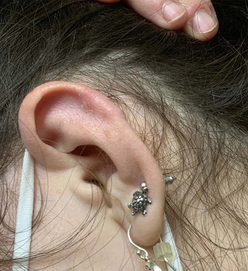 Earlobe Repair