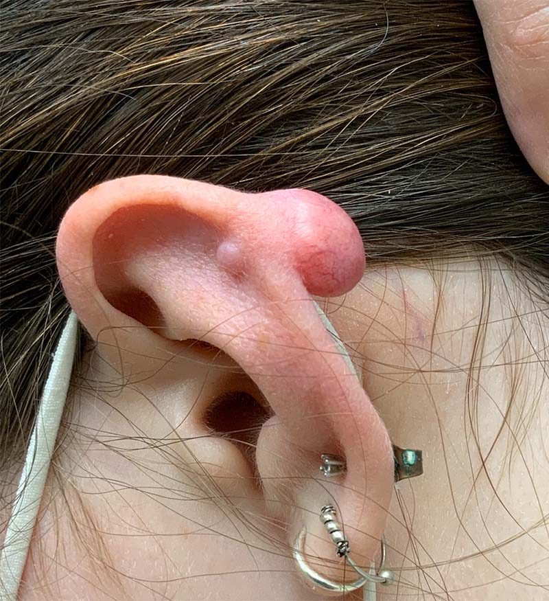 Earlobe Repair