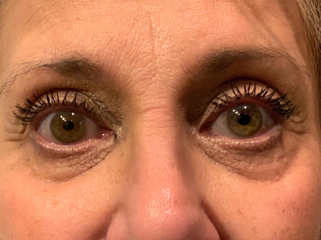 Eyelid and Upper Facial Surgery