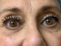 Eyelid and Upper Facial Surgery