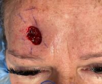 Skin Cancer Reconstruction