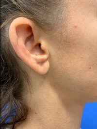 Earlobe Repair