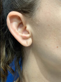 Earlobe Repair